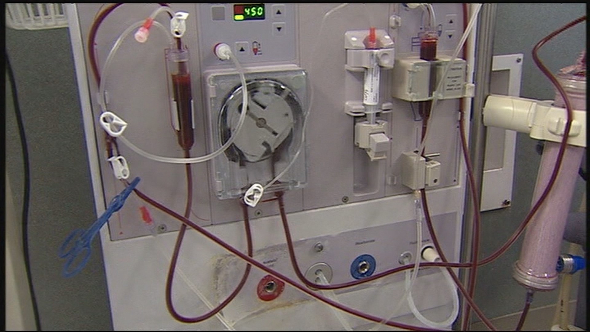 Texas Children's Hospital performs 4 kidney transplants in one day